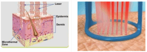 Fractional CO₂ Laser – Scar & Skin Renewal